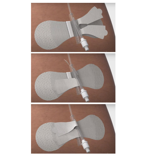 Foley Catheter Securement Foley Catheter Securement