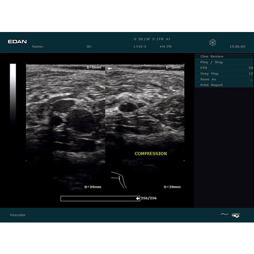 Edan Digital Diagnostic Ultrasound System DUS 60