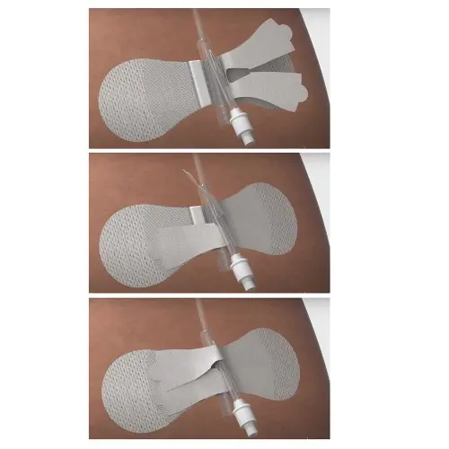 Foley Catheter Securement
